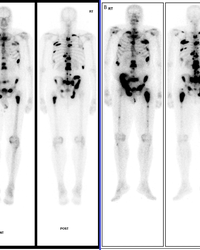 Fig. 2 (A) Bone scan of a symptomatic 62-year-old man with Gleason 8 prostate cancer and rapidly rising PSA (88ng/ml; PSA doubling time 2 months) under hormone treatment shows widespread multimetastatic disease. (B) Re-assessment after 5 cycles of docetax