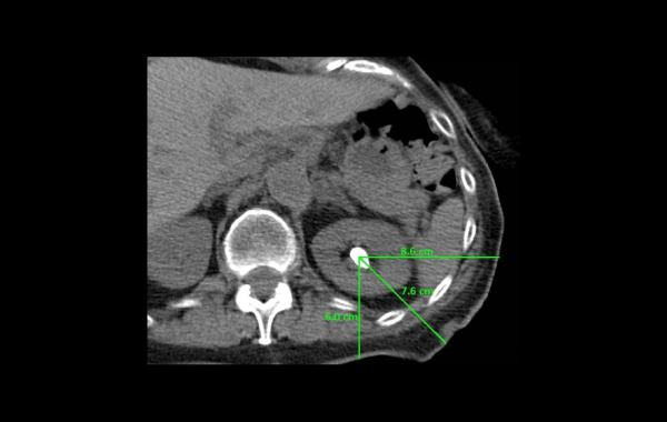 BJUI Knowledge: Urolithiasis And Endourology