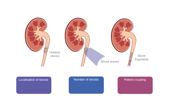 BJUI Knowledge: Urolithiasis And Endourology